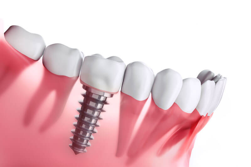 Implantologie in der Zahnartztpraxis Katerina Luyken in Grunewald