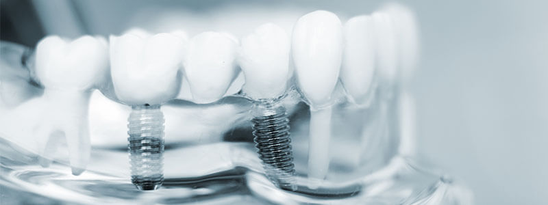 Implantologie in der Zahnartztpraxis Katerina Luyken in Grunewald